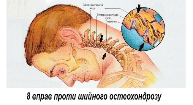 1-osteohondroz (1)