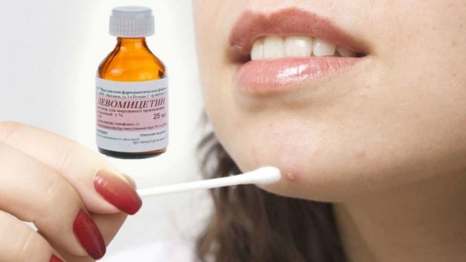 levomicetin-ot-pryshhej1-768x432-1