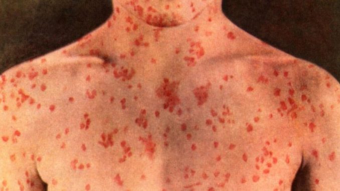 5bd7576ce925b-measles-1-800x445-1